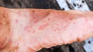 We can match any comparable quote for scabies mites removal. Bed Bugs Vs Scabies Bites What S The Difference
