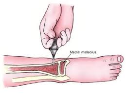 Image result for Intraosseous Access