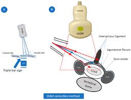 Image result for Lower Cervical Intramuscular Injection
