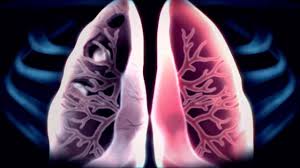 From tb suspects attending a chest clinic in nairobi, kenya, three sputum specimens were examined for zn and culture (lowenstein jensen). Tuberculosis X Ray Youtube