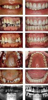 Diy solutions for rotten teeth. Decayed Teeth And Rotten Teeth Treatments