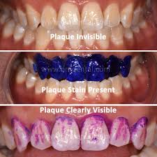 It is a sticky colorless deposit at first, but when it forms tartar. Dental Scaling And Polishing Teeth Cleaning In Singapore B F Dental Clinic Singapore
