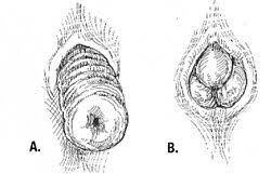Image result for Rectal Prolapse