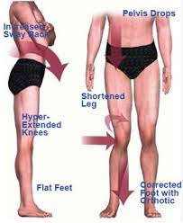Pin On Leg Braces Calipers Splints Braces Wheelchair 1960 S One Leg Longer Than The Other