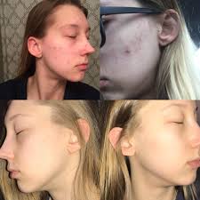 B&A] Diane 35 Birth Control : r/SkincareAddiction