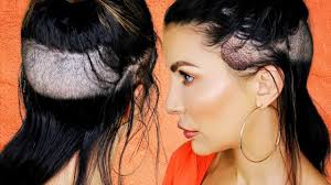The reason that this treatment is referred to by this name is that artificial or natural human hair purchased by the salon client is woven into the client's natural hair, quite close to the scalp. I Got A Hair Transplant My Emotional Female Hair Transplant Surgery Experience Youtube
