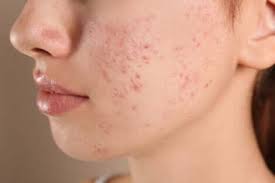 Ahead, dermatologists share how birth control can lead to clearer skin and the best brands to try for acne treatment. Birth Control For Skin Types And Effects Step To Health Medication