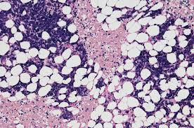 We are experts at treating all types of bone and soft tissue tumors in. What Are Bone Lesions Causes And Symptoms