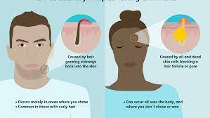 Difference Between A Pimple And An Ingrown Hair