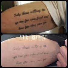 This is just a general average, so make sure that you consult with our experts to determine the exact cost for you. How Much Does Tattoo Removal Cost In Portland Oregon