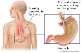 Xiphoid Process Pain (Xiphoidalgia): The Ultimate Guide