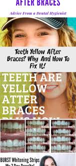 Effective aligners · have your smile assessed · indivudual treatment How To Whiten Teeth Overnight With Braces Arxiusarquitectura