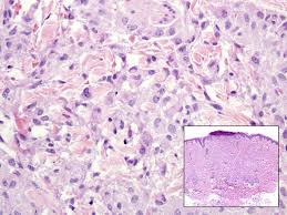 Does every necrotizing granulomatous inf. Histopathologic Review Of Granulomatous Inflammation Abstract Europe Pmc