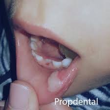 Tratamiento Del Mucocele Mucocele Que Es Y Como Se Cura