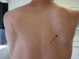 Image result for Snapping Scapula