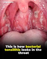 Image result for Tonsillitis