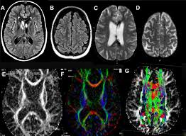 Image result for Diffuse Axonal Injury