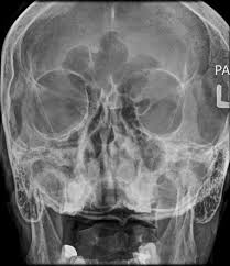 Image result for Sinus X Ray
