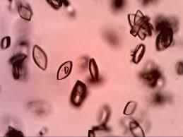 Calcium oxalate monohydrate raphides or solitary calcium oxalate dihydrate crystals. Cristale De Acid Uric In Sedimentul Urinar Medical Center Dorohoi