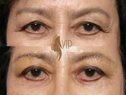 Dr Andrew K Choi Vip Plastic Surgery Los Angeles Under Eyebrow Lift Was Performed To Raise Sagging Brows That A Eyelid Surgery Plastic Surgery Eyebrow Lift