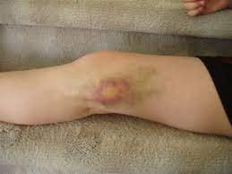 Bol u palcu noge može biti jako neprijatan i uznemirujući. Hematom Uzroci Rizici I Lijecenje Treca Dob Hrvatska