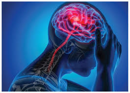 Just as strokes have many effects, they also have many causes. Early Management Of Patients With Acute Ischemic Stroke 2019 Update Pharmacy Today