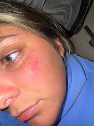 What helps lupus rash?