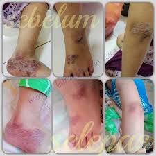 Kudis buta atau lebih popular dengan bahasa perubatan scabies merupakan keadaan kulit kita yang kelihatan merah dan gatal akibat gigitan hama kecil yang kita panggil sarcoptes scarbei. Ubat Kulit Untuk Kudis Kurap Kayap Dan Makan Air Free Gift Shopee Malaysia