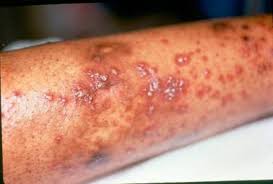 It looks like purple or dark red larger spots. Henoch Schonlein Purpura Johns Hopkins Vasculitis Center
