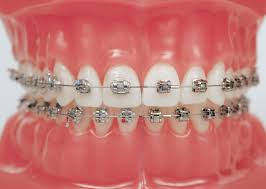 This Is What Braces Will Look Like For Me Soon Dental Braces Orthodontics Braces Orthodontics