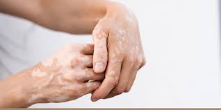 Image result for Vitiligo