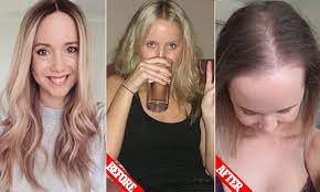 Can taking birth control pills make your hair fall out? Woman 33 Reveals How She Lost 70 Per Cent Of Her Hair After Switching Contraceptive Pill Daily Mail Online