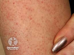 Image result for Keratosis pilaris