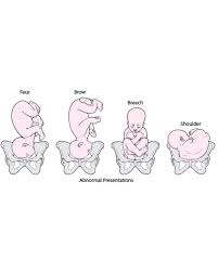 Image result for Shoulder Presentation