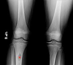 Image result for Osteomyelitis XRay