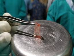 A revolutionary multipurpose autogenic biomaterial. Novel Use Of Platelet Rich Fibrin Membrane In Transcanal Myringoplasty A Prospective Study Springerlink