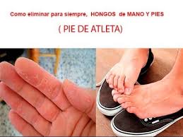 Hongos En Las Uñas De Las Manos Como Eliminarlos Como Eliminar Los Hongos De Pies Y Manos Comprobado Remedios Caseros Hongos