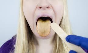 Image result for yellow tongue infection