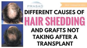Losing your hair is not usually anything to be worried about, but it can be upsetting. Hair Falling Out Shedding After Hair Transplant Nyc