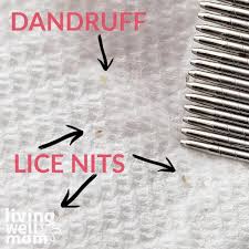 Image result for lice vs dandruff