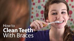 How makeup can the bleaching solution would be placed in a tray that looks like an athletic mouthguard. What Happens If You Have Braces And Don T Brush Your Teeth