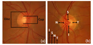 The optic nerve is vulnerable to getting damaged by pressure in the eyes, called ocular hypertension. Osa Automatic Glaucoma Classification Using Color Fundus Images Based On Convolutional Neural Networks And Transfer Learning