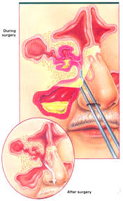 Sinus Surgery: When Is It Necessary?