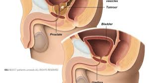 Image result for Radical Prostatectomy