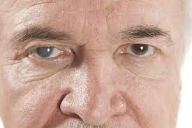Understanding The 3 Different Types Of Cataracts Drs Campbell Cunningham Taylor And Haun