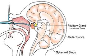 Surgery of Pituitary Tumor: Complete Guide to Treatment and Recovery