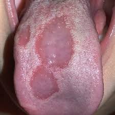Image result for lichen planus on tongue)