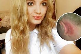 Hair dye allergy on skin in and around moustache by: This Teenager Had A Frightening Reaction To Hair Dye When She Was Given A Precautionary Allergy Test Wales Online