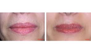 There's a science bit too with detail you just like professional treatments most home laser and most ipl hair removal are effective on common areas are the upper lip, chin, jawline, sideburns, armpits, forearms, tummy, bikini line. Laser Hair Removal Clinic Mumbai Safe Pain Free Treatment