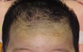 My daughter also has what seems to be very slow hair growth. Cradle Cap In Adults Can Be Embarrassing We Explore Cradle Cap Treatments For Adults As Well As How To Get Cradle Cap Cradle Cap Treatment Cradle Cap Remedies